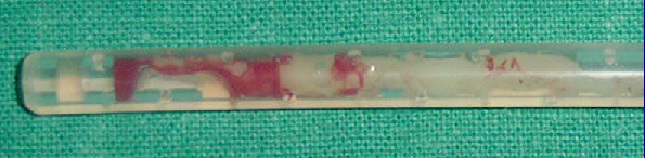 Fibrina ostruisce un catetere peritoneale