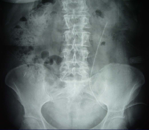 Radiografie in un paziente con dislocazione del catetere peritoneale