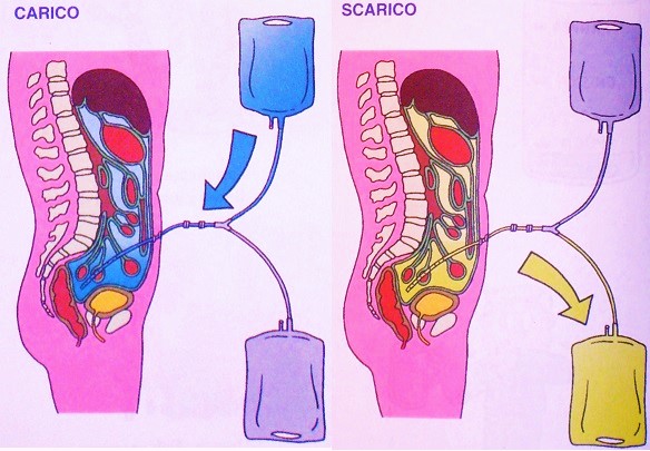carico e scarico in dialisi peritoneale