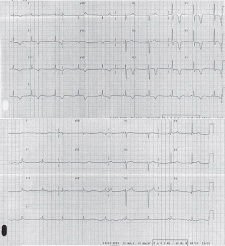ecg 3 cardiomiopatia takotsubo