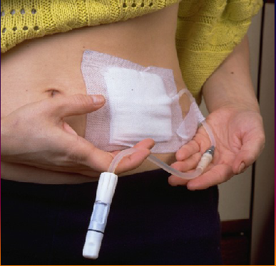 dialysis peritoneal peritoneale dialisis capd fistula dialisi catetere paziente ambulatory darah assistenza infermieristica guida completa  kateter perut catter selang