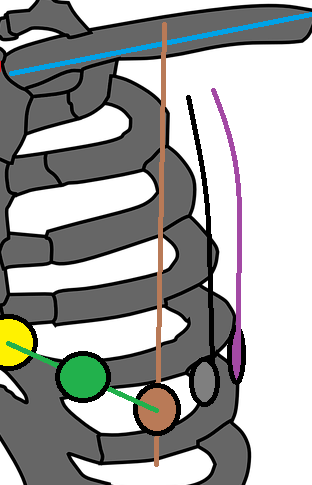 Come posizionare gli elettrodi v5 e v6