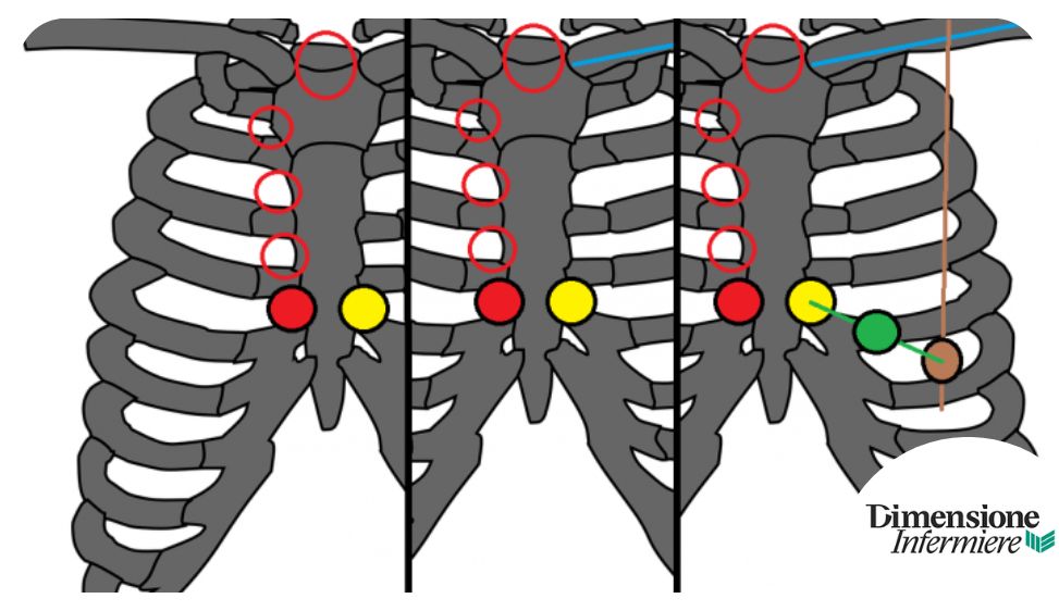 Procedura ElettroCardioGramma: corretta posizione degli ...