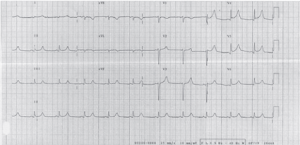 ecg 1 cardiomiopatia takotsubo