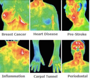 termografia mammaria - cos'è la termografia