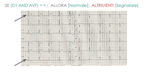 Come verificare se l'asse elettrico all'ECG è corretto