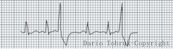 Leggere l'ECG: Elettrocardiogramma extrasistoli. Dario Tobruk ®.
