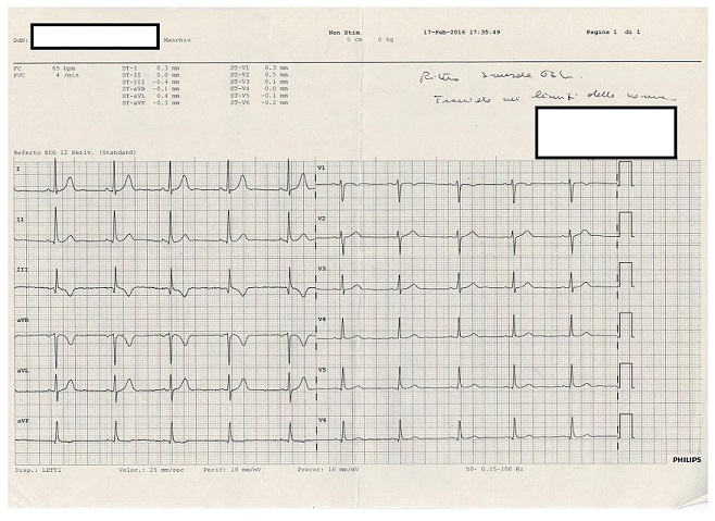 Esempio di un elettrocardiogramma normale