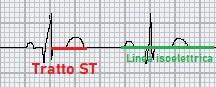 Leggere l'ECG: Tratto ST e Linea isoelettrica. Dario Tobruk ®