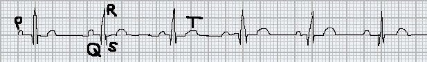 Leggere l'ecg