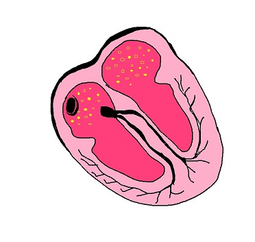 La fibrillazione atriale è una delle principali aritmie cardiache