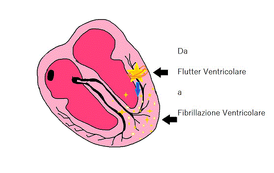 flutter ventricolare e fibrillazione ventricolare Dario Tobruk ©