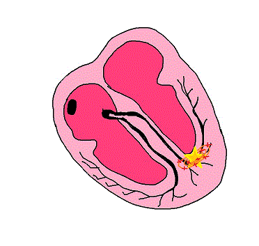 tachicardia ventricolare Dario Tobruk ©