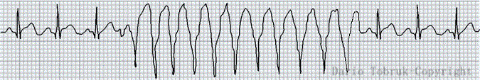 Come si presenta al tracciato ECG la tachicardia ventricolare non sostenuta o TVNS