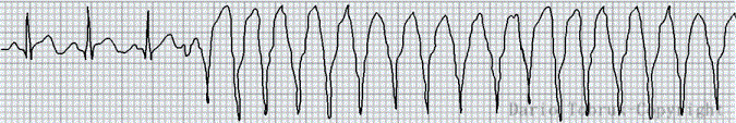 Come si presenta al tracciato ECG la tachicardia ventricolare  o TVS
