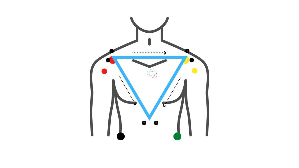 Triangolo di Einthoven sul torace del paziente. Dario Tobruk © realizzato con Canva.com versione Pro