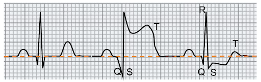 Segni di Stemi e NSTEMI nell'elettrocardiogramma