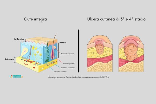 Cute integra e ulcere cutanee - Copyright immagine Servier Medical Art - smart.servier.com - (CC BY 3.0) (1)