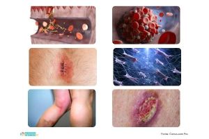 Il processo di guarigione delle ferite cutanee e le sue fasi
