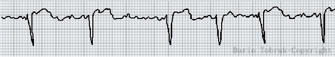 Come riconoscere la fibrillazione atriale dall'ECG? È semplice, basta... 2 Fibrillazione atriale. Dario Tobruk ®.