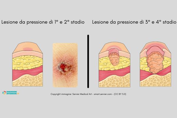 Stadiazione Lesioni da pressione NPUAP/EPUAP - Copyright immagine Servier Medical Art - smart.servier.com - (CC BY 3.0) (1)