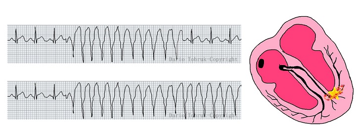 tachicardia ventricolare sostenuta e non sostenuta