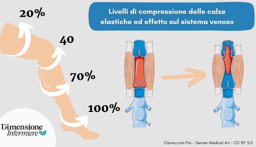 Livelli di compressione delle calze elastiche ed effetto sul sistema venoso