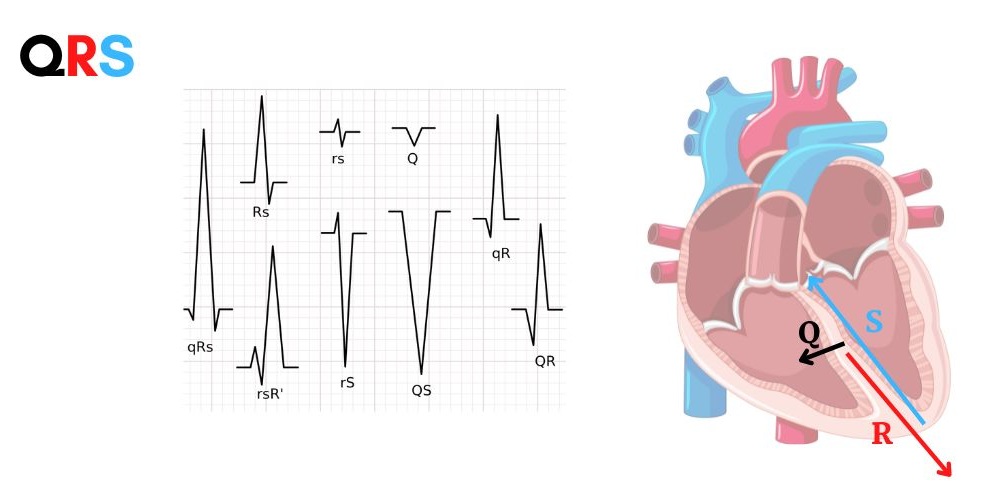Complesso QRS nelle sue variazioni realizzato con Canva.com Pro. Immagine tratta da ECG Facile dalle basi allessenziale Dario Tobruk ©