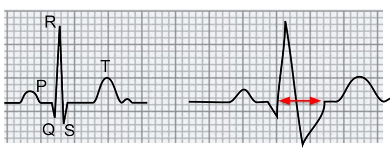 Complesso QRS normale e QRS slargato. Dario Tobruk ®