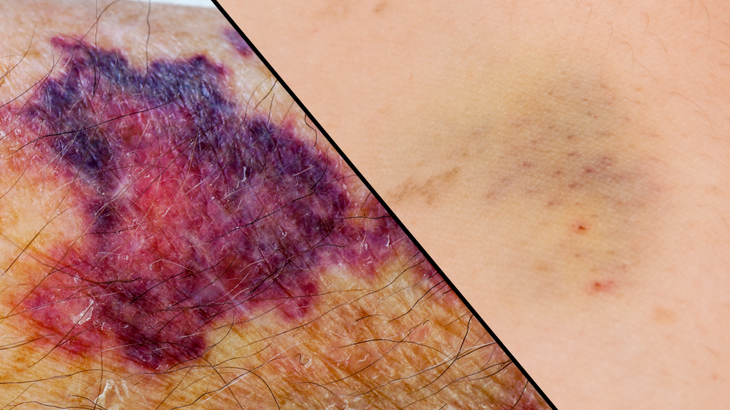 Ematoma dopo il prelievo ematico: come prevenirlo e quando preoccuparsi 1 Confronto ravvicinato tra ematoma esteso e ecchimosi superficiale sulla pelle