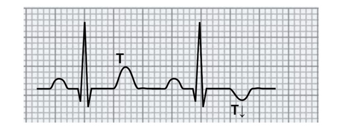 Onda T positiva e onda T negativa. Dario Tobruk ®. Immagine tratta da ECG Facile dalle basi allessenziale