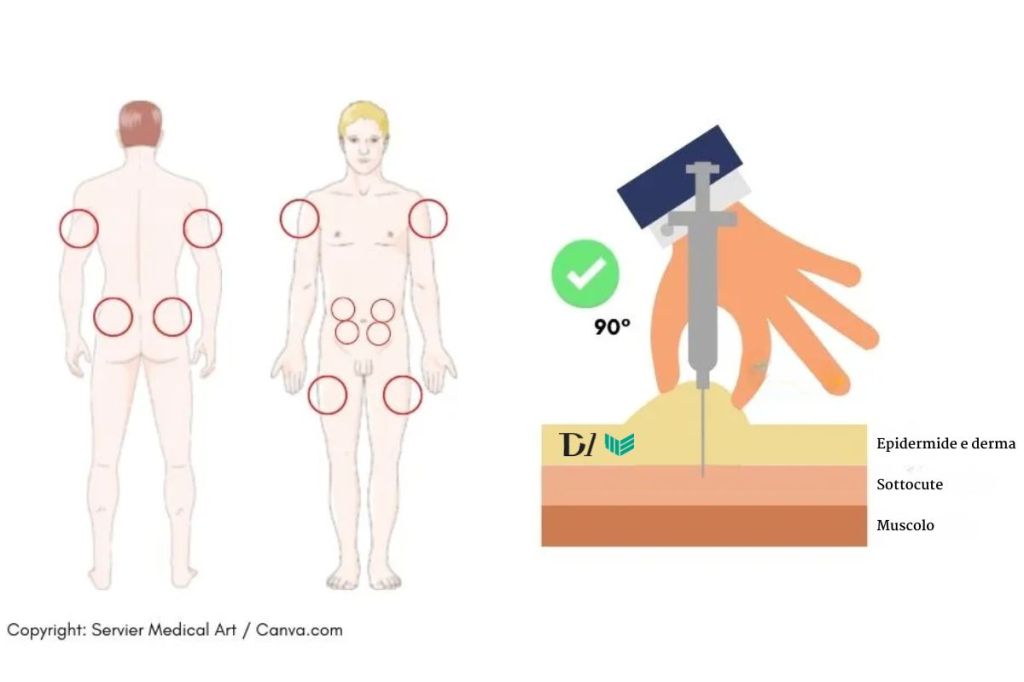 Come si fa una iniezione di eparina? Una guida completa 1 Schema delle sedi per l’iniezione sottocutanea di eparina e illustrazione della corretta angolazione di somministrazione