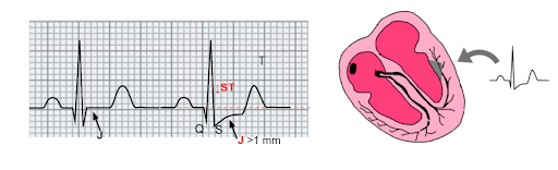 Come riconoscere un infarto miocardico acuto dall'ECG? Semplice... 3 Segni suggestivi di ischemia subendocardica NSTEMI. Copyright Dario Tobruk