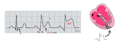 Come riconoscere un infarto miocardico acuto dall'ECG? Semplice... 4 Segni suggestivi di ischemia transmurale STEMI allECG. Dario Tobruk