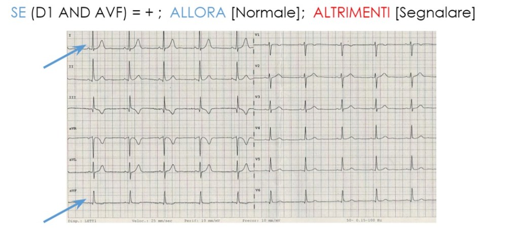 Interpretazione dell'ECG: metodo facile per la lettura dell'elettrocardiogramma 15 asse elettrico normale