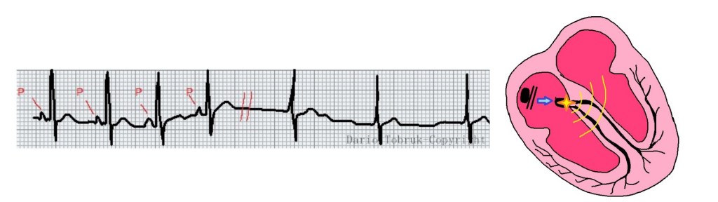 Interpretazione dell'ECG: metodo facile per la lettura dell'elettrocardiogramma 8 ritmo scappamento giunzionale nel tracciato ecg. Immagini tratte da ECG Facile dalle basi allessenziale Dario Tobruk ©