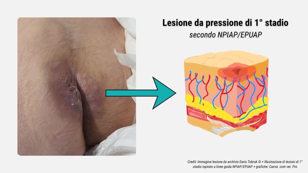 Guida rapida alla stadiazione delle lesioni da pressione secondo NPIAP-EPUAP 2 Immagine e illustrazione di lesione da pressione di 1° stadio secondo linee guida NPIAP/EPUAP