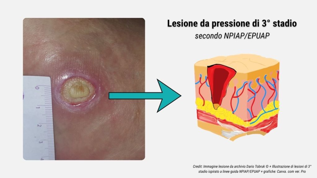 Guida rapida alla stadiazione delle lesioni da pressione secondo NPIAP-EPUAP 4 Illustrazione e immagine di una lesione da pressione di 3° stadio secondo le linee guida NPIAP-EPUAP