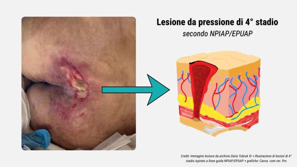 Guida rapida alla stadiazione delle lesioni da pressione secondo NPIAP-EPUAP 5 Illustrazione e immagine di una lesione da pressione di 4° stadio secondo le linee guida NPIAP-EPUAP